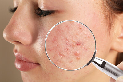 Acne Scar Improvement